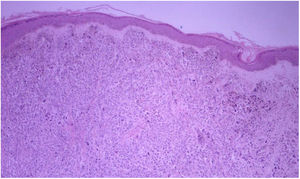 Piel con metástasis de melanoma. Hematoxilina-eosina ×40. Piel con metástasis de melanoma. Epidermis delgada sin melanoma in situ. Dermis infiltrada por proliferación melanocítica dispuesta en patrón sólido y nidos.