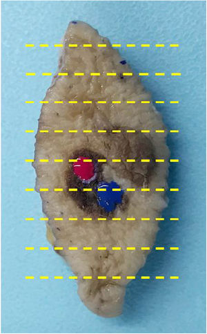 Pieza de resección en huso con lesión pigmentada heterogénea en la que se muestran 2áreas marcadas con esmalte ungueal, en colores rojo y azul.