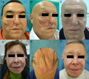 Alopecia difusa por vismodegib (inhibidor de la vía Hedgehog) en pacientes incluidos en el estudio STEVIE. A) Paciente varón antes de empezar el tratamiento. B) A los 8 meses de tratamiento. C) A los 3 meses de la suspensión del tratamiento. D) Paciente mujer antes de empezar el tratamiento. E) A los 9 meses de tratamiento. F) A los 3 meses de finalizar el tratamiento. Cortesía de la Dra. V. Ruiz-Salas.