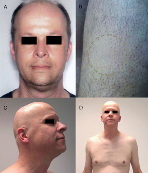 Alopecia areata (AA) universal por alemtuzumab (anti-CD52). A) Aspecto antes del tratamiento. B) Placas iniciales de AA en piernas. C y D) Fase final de AA universal. Fuente: Van der Zwan et al.91.