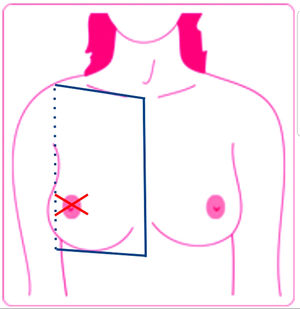 Metástasis cutánea locorregional: metástasis cutánea localizada en un área, homolateral al tumor primario, delimitada superiormente por la clavícula, inferiormente por el borde costal, medialmente por el esternón y lateralmente por la línea axilar posterior. Metástasis cutáneas a distancia son aquellas localizadas por fuera de estos límites. Tomado de Lookingbill et al.1.