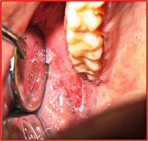 Segunda paciente. Fotografía previa al tratamiento en la que se muestra una lesión eritematosa reticular en la mucosa bucal.