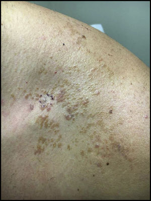 Lesión en zona anterior del hombro con aspecto marrón moteado y áreas eritematosas.