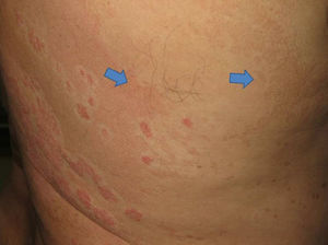 Máculo-placas de color marrón rojizo, descamativas, que confluían sobre amplias áreas del tronco, indicativa de pitiriasis versicolor (flechas azules).