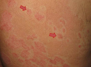 Placas eritematosas, queratósicas, sugestivas de psoriasis vulgar (flechas rojas).