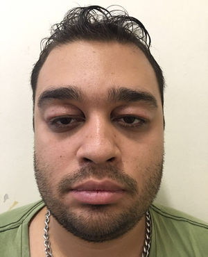 Redundancia del párpado.