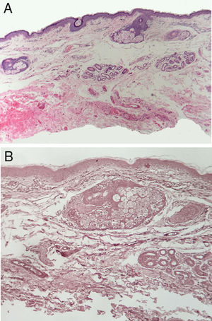 Estudio histopatológico de la piel palpebral. A) Se aprecia únicamente edema leve en la dermis superior (40X, HE). B) Ausencia de fibras elásticas en la dermis del párpado (100X, orceína).