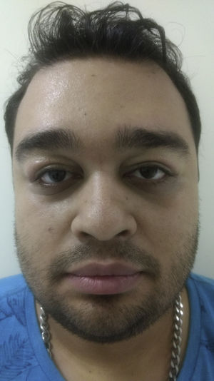 Resultados excelentes tras la blefaroplastia.