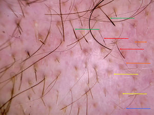Imagen con DermLite® II Hybrid (3Gen™) del borde de la placa de alopecia. Flechas rojas: pelos con constricciones de Pohl-Pinkus o moniletrix-like. Flechas verdes: pelos peládicos o en forma de signo de exclamación el extremo distal engrosado. Flechas amarillas: puntos amarillos. Flechas naranjas: vellos cortos. Flecha azul: pelo angulado.