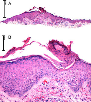 A) Imagen panorámica, presencia de una lámina de paraqueratosis oblicua sobre una epidermis acantósica (H&E ×2). B) A mayor detalle: epidermis con una depresión central asociada a una columna de paraqueratosis oblicua e hipogranulosis (H&E ×4).