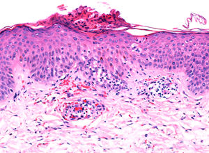 Epidermis acantósica asociada a espongiosis, extravasación eritrocitaria, tumefacción endotelial y daño vacuolar de la capa basal (HE x10).