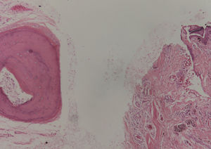 Nidos de células névicas benignas en la dermis papilar y por debajo de ellos presencia de espículas óseas con osteocitos y osteoblastos. Hematoxilina-eosina, ×4.