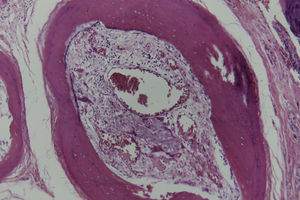 Espícula con presencia de megacariocitos y precursores de línea blanca y roja de la sangre en la pulpa amarilla de la médula ósea. Hematoxilina-eosina, ×10.