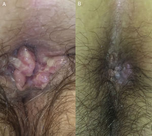 Caso 2. A. Se observa una lesión excrecente en la región perianal. B. Se observa la evolución de dicha lesión tras la infiltración de una dosis de 0,3ml de cidofovir intralesional.