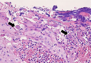 Histología del caso 2. La histología muestra una célula epitelial con un núcleo grisáceo y cromatina marginada (flecha izquierda). Las mismas características nucleares se observan en una célula epitelial multinucleada (flecha derecha) (hematoxilina-eosina, 40x).