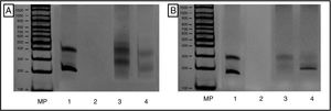 Evaluación de reordenamientos de la cadena gamma del receptor de células T, mediante reacción en cadena de la polimerasa (PCR) múltiple. Resultados visualizados en gel de poliacrilamida al 6%, de acuerdo con los protocolos BIOMED-2, así: A) Receptor células T Vγ1-8 y Vγ10. B) TCR Vγ9 y Vγ1. MP: marcador de peso. 1: control positivo InVivoScribe «0021»; 2: Mix PCR & agua grado biología molecular en lugar de ADN; 3: control policlonal «Pool de linfocitos de pacientes sanos», y 4: Caso del paciente donde se observa producto monoclonal alrededor de 200 nucleótidos de las regiones receptor de células T Vγ9 y Vγ11.