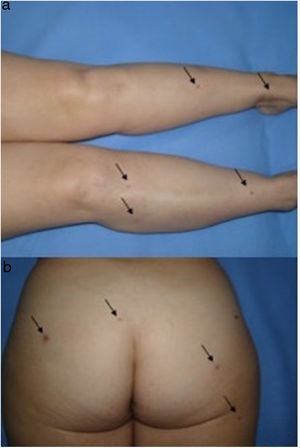 Dermatofibromas múltiples. Pápulas eruptivas de coloración marrón a violácea y consistencia firme localizadas en los miembros inferiores (a) y los glúteos (b) de la paciente.