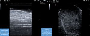 Estudio ecográfico en modo B de las metástasis cutáneas de las pacientes 2 y 6.