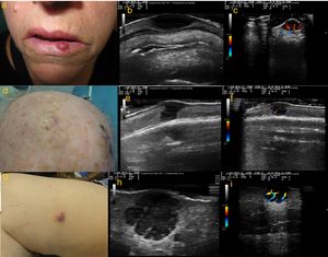 a) Caso 1: lesión eritematosa e infiltrada, de consistencia firme, de 1cm de diámetro en hemilabio inferior izquierdo; b) Modo B: lesión hipoecoica homogénea localizada en dermis, con bordes bien delimitados; c) Modo Doppler color: importante vascularización de predominio en la zona basal; d) Caso 2: nódulo subcutáneo con piel suprayacente de coloración rosada de 8mm de diámetro, localizado en región parietal derecha; e) Modo B: lesión hipoecoica dermoepidérmica; f) Modo Doppler color: señal Doppler leve perilesional; g) Caso 3: nódulo de coloración rosada de 18mm de diámetro en cara interna de muslo derecho; h) Modo B: lesión hipoecoica polilobulada localizada a nivel dermo-hipodérmico, con bordes bien delimitados y refuerzo acústico posterior. En su interior se visualizan septos hiperecoicos; i) Modo Doppler color: vascularización intralesional de predominio en septos.