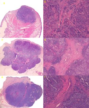 a) Caso 1: lesión con patrón sólido de crecimiento con bordes ligeramente espiculados. Hematoxilina-eosina (H&E); b) Detalle de trabéculas fibrosas en forma de tractos finos con escasas estructuras vasculares (H&E ×100); c) Caso 3: tumoración con bordes mejor delimitados y estructura lobulada, con tractos fibrosos que se parece corresponder con las líneas intralesionales hiperecogénicas que se visualizan en la ecografía cutánea en modo B (H&E); d) Detalle de tractos fibrosos gruesos con numerosas estructuras vasculares en su interior (H&E ×40); e) Caso 4: lesión lobulada con tracto fibroso grueso perpendicular a la epidermis, que parece corresponderse ecográficamente con línea hipoecoica visualizada en modo B; f) Detalle de tracto fibroso grueso central con estructuras vasculares de mayor calibre que en el caso 3 (H&E ×100).