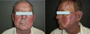 IPN clínica del nervio facial.