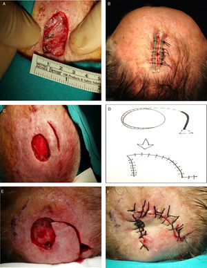 Reconstrucción de defectos con distancia de aproximación menor de 2cm. (A) Medida de la distancia de aproximación. Si esta distancia es menor de 1cm se aconseja sutura reforzada con sonda (B). Si está entre 1 y 2cm, realizar una incisión de descarga (C) y si no cierra ampliación al colgajo de rotación (D-F).