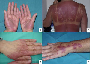 A. Eritema acral inducido por quimioterapia. B. Eritema acral inducido por quimioterapia con distribución atípica en el dorso de las manos. C. Reacción de evocación de quemadura solar. D. Necrólisis epidérmica localizada en el lugar de la inyección.