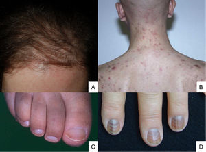 A. La alopecia posquimioterapia es difusa, aparece en las primeras semanas del tratamiento y respeta el borde de implantación del cabello. B. Foliculitis tras la administración de dactinomicina; C. Uñas mitad-mitad. D. Líneas de Muehrcke con pigmentación difusa después de la administración de ciclofosfamida.