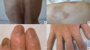 A. Hiperpigmentación difusa. B. Hiperpigmentación postinflamatoria. C. Melanoniquia longitudinal. D. Nevi eruptivos.