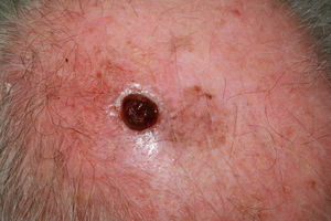 Melanoma nodular amelanótico de rápido crecimiento en la sien izquierda, ulcerado, en paciente varón de 87 años de 4 meses de evolución, índice de Breslow de 7mm y 8 mitosis por mm2.