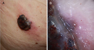 A) Melanoma nodular de rápido crecimiento en 3meses en la zona escapular derecha sobre una lesión plana previa de años de evolución. Mostró un índice de Breslow de 4mm, no ulcerado y presencia de 5 mitosis por mm2. Presencia de melanoma in situ perilesional en el estudio histopatológico. B) Detalle de la base de la lesión donde se observa pigmentación correspondiente al componente in situ de la lesión previa.