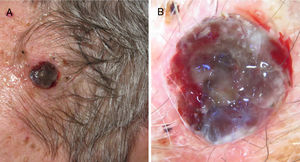 A) Melanoma nodular de rápido crecimiento en 4 meses en la sien izquierda con índice de Breslow de 4mm, ulcerado y presencia de 10 mitosis por mm2. B) Dermatoscopia de la lesión donde se observan varios colores y pequeñas áreas lechosas con vascularización atípica.