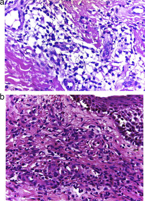 a) Histología caso 1: infiltrado difuso de eosinófilos dispersos con invasión de vasos sanguíneos superficiales necrosados. b) Histología caso 2: necrosis fibrinoide de los vasos sanguíneos superficiales rodeada por eosinófilos. Aumento 10×.