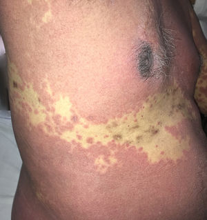 A más aumentos, la zona preservada muestra hiperpigmentación y cicatrices del herpes zóster curado quedando preservado el dermatoma T9 de la erupción cutánea.