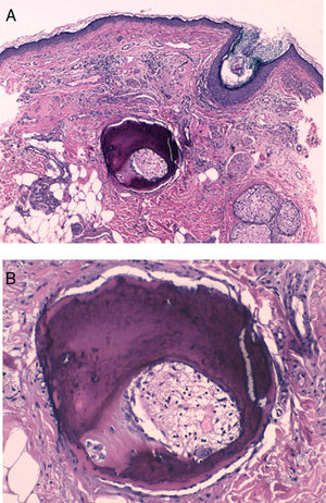 Estudio histológico. A) Hematoxilina-eosina ×40. B) Hematoxilina-eosina ×200.