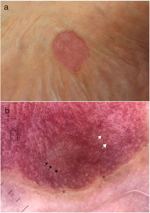 Caso 1. a)Imagen clínica. b)Imagen dermatoscópica: se observa el borde descamativo en escalera (asterisco), un punteado blanco regular (flechas negras), líneas blanquecinas (flechas blancas) sobre un fondo eritematoso con vasos puntiformes, algunos de los cuales se distribuyen alrededor de los puntos blancos (recuadro negro).