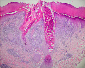 Lobulación de epidermis hacia dermis y queratinocitos con cuerpos de inclusión intracitoplasmáticos (hematoxilina-eosina ×4).
