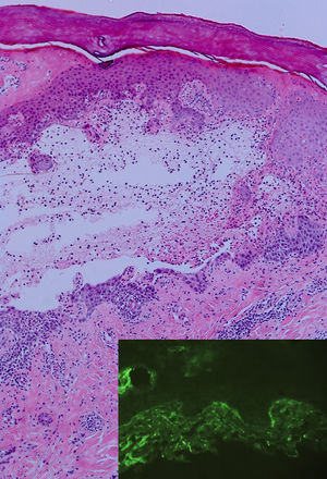 H-E ×20: ampolla subepidérmica parcialmente reepitelizada con infiltrado inflamatorio por neutrófilos y eosinófilos. En superposición puede observarse IFD con depósitos lineales focales de C3 en membrana basal.