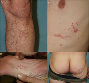 Caso 3. Herpes zoster multiplex que presenta vesículas agrupadas con distribución zosteriforme que afectan los dermatomas L5 izquierdo (A y B, cresta tibial y arco plantar), D6 izquierdo (C) y S2 derecho (D).