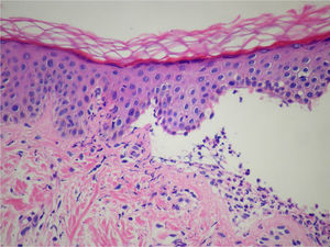 Histología en dermatosis ampollar IgA lineal. La imagen muestra una ampolla subepidérmica con infiltrado inflamatorio de predominio neutrofílico en la dermis (tinción hematoxilina-eosina [H&E]).