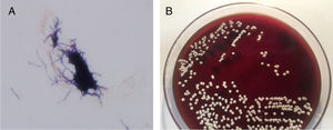 La tinción de Gram mostró cocobacilos grampositivos formando filamentos ramificados (A) y en el cultivo en agar sangre crecieron colonias de Nocardia brasiliensis (B).