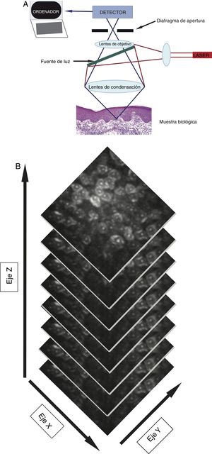 A) Un láser de baja intensidad (< 30 mW), no ablativo, incluirá una fuente de luz, elementos para escaneo, telescopio de retransmisión, divisor de haces, diafragma de apertura, lentes de objetivo y un detector que genere imágenes de las estructuras brillantes y oscuras cutáneas. B) Apilamiento representativo de las imágenes, que revelan las características desde la epidermis hasta la dermis reticular superior.