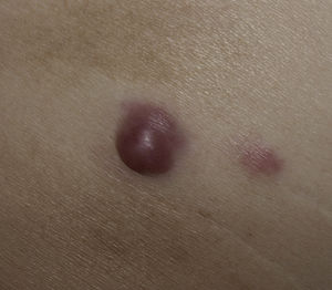 Imagen clínica. Nódulo cupuliforme de color rosado y superficie lisa de 2cm en glúteo derecho, con base subcutánea infiltrada y un nódulo satélite adyacente.