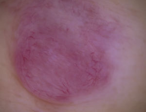 Imagen dermatoscópica. Color rosa salmón homogéneo con múltiples vasos prominentes mal enfocados lineales irregulares o «en serpentina», distribuidos predominantemente en la periferia del nódulo. Estructuras blanquecinas en el centro de la lesión.