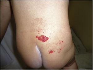 Hemangioma segmentario lumbosacro con desviación de la línea media hacia el lado izquierdo.