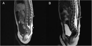 A) RM T1 4mm lipoma. B) RM T2 filum terminale con médula espinal atrapada.
