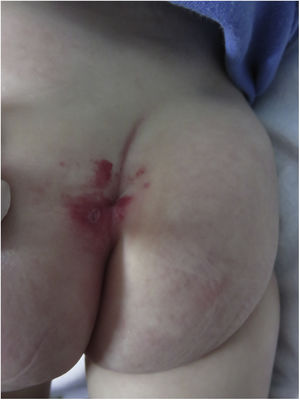 Hemangioma de 4cm ulcerado, localizado en el pliegue interglúteo.