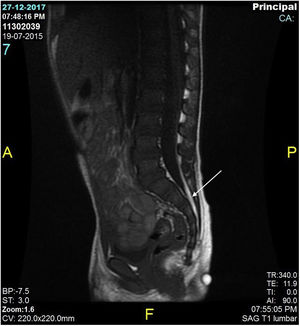 RM T1 lipoma del filum terminale.