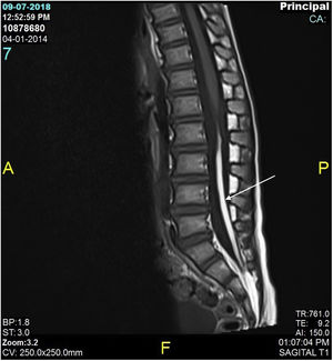 RM T1 lipoma del filum terminal al S2.
