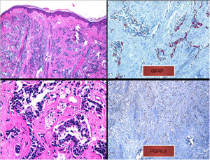 a) Infiltrado difuso en dermis papilar y reticular de células tumorales sin contacto con la epidermis (tinción hematoxilina-eosina, x10). b) Células tumorales de núcleo hipercromático y marcado pleomorfismo (tinción hematoxilina-eosina, x40). c) Inmunohistoquímica positiva para la tinción de proteína glial fibrilar ácida (x40). d) inmunohistoquímica positiva para la tinción de PGP9.5 (x20).
